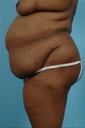 Side View Before Abdominoplasty and Liposuction