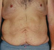 Front View Before Tummy Tuck