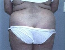 Rear View Before Liposuction & Mini Tummy Tuck